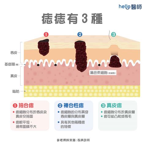 臉部黑痣|痣形成的原因？痣長毛、痣變多變大是痣病變？5招判。